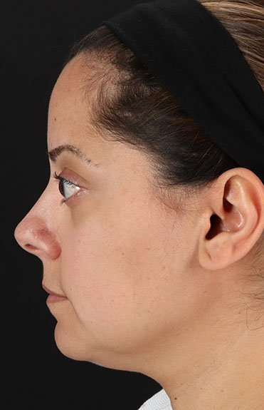 Neck Liposuction Before & After Patient #2752