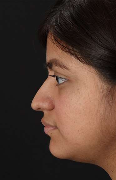 Neck Liposuction Before & After Patient #2763