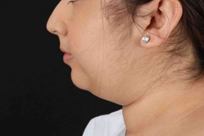 Neck Liposuction Before & After Patient #2774