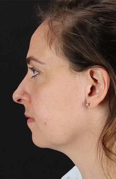 Neck Liposuction Before & After Patient #2785