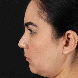 Browlift Before & After Patient #1341