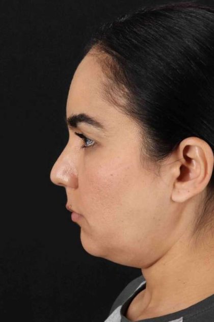 Browlift Before & After Patient #1341