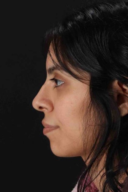 Rhinoplasty Before & After Patient #2818