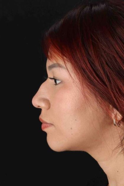 Rhinoplasty Before & After Patient #2829