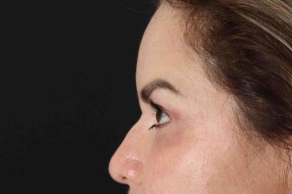 Rhinoplasty Before & After Patient #2840