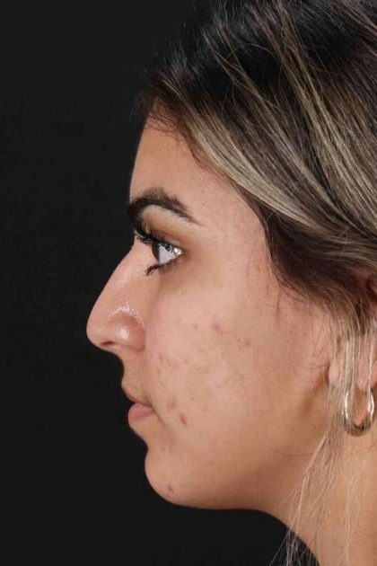 Rhinoplasty Before & After Patient #2862