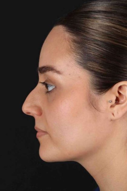 Rhinoplasty Before & After Patient #2873