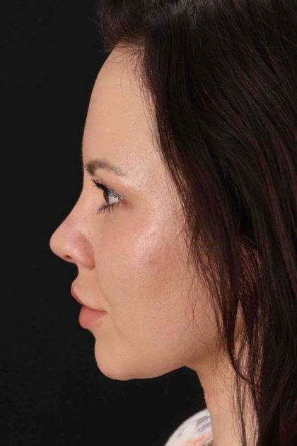 Rhinoplasty Before & After Patient #2884