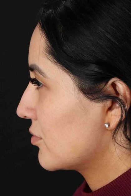 Rhinoplasty Before & After Patient #2895