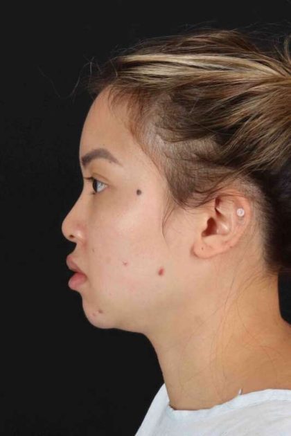 Rhinoplasty Before & After Patient #2906