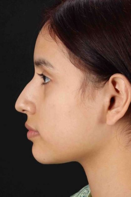 Rhinoplasty Before & After Patient #2917