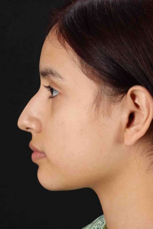 Rhinoplasty Before & After Patient #2917