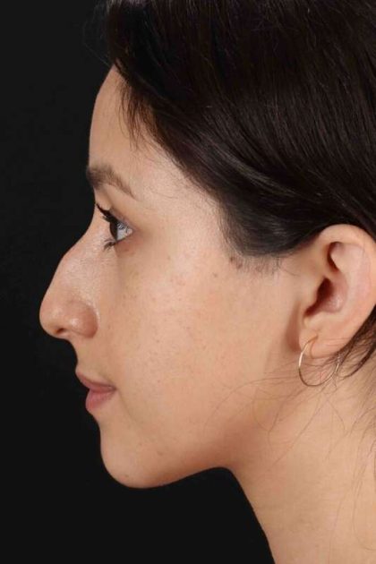 Rhinoplasty Before & After Patient #2928