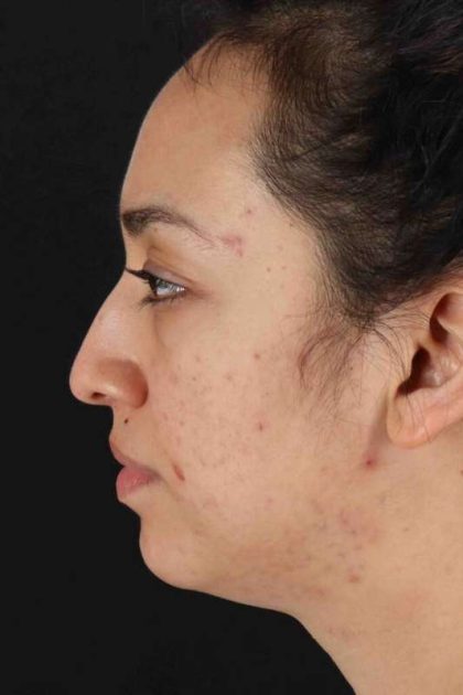 Rhinoplasty Before & After Patient #2939