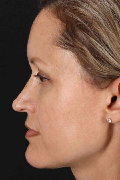 Rhinoplasty Before & After Patient #2950