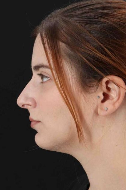 Rhinoplasty Before & After Patient #2961