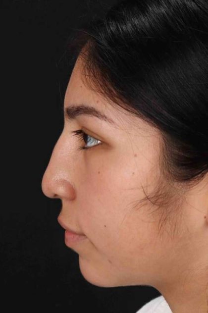 Rhinoplasty Before & After Patient #2972