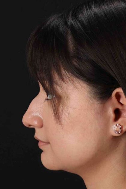 Rhinoplasty Before & After Patient #2983