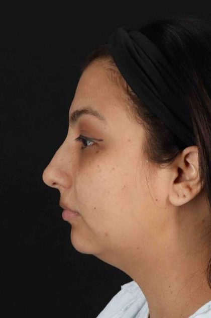 Rhinoplasty Before & After Patient #2994