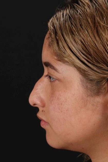 Rhinoplasty Before & After Patient #3016