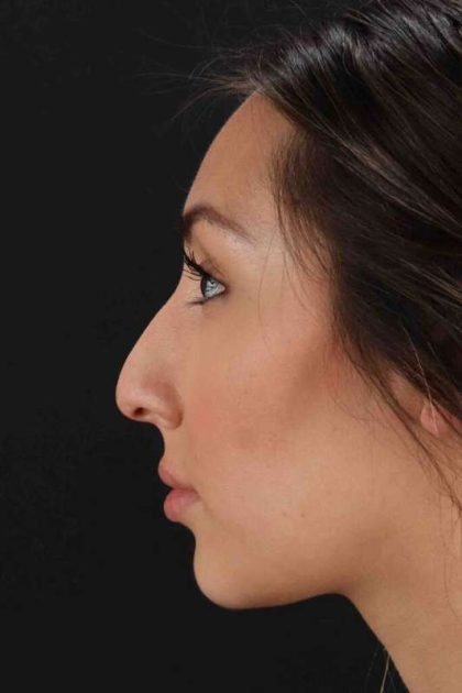 Rhinoplasty Before & After Patient #3027