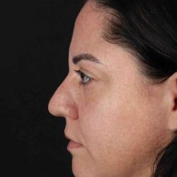 Browlift Before & After Patient #1363
