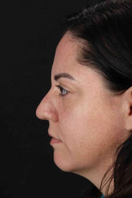 Browlift Before & After Patient #1363