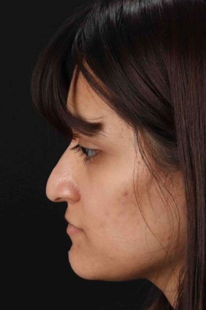 Rhinoplasty Before & After Patient #3038