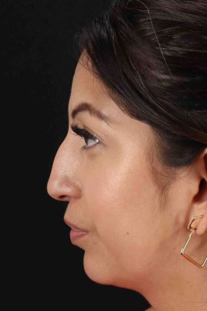 Rhinoplasty Before & After Patient #3049