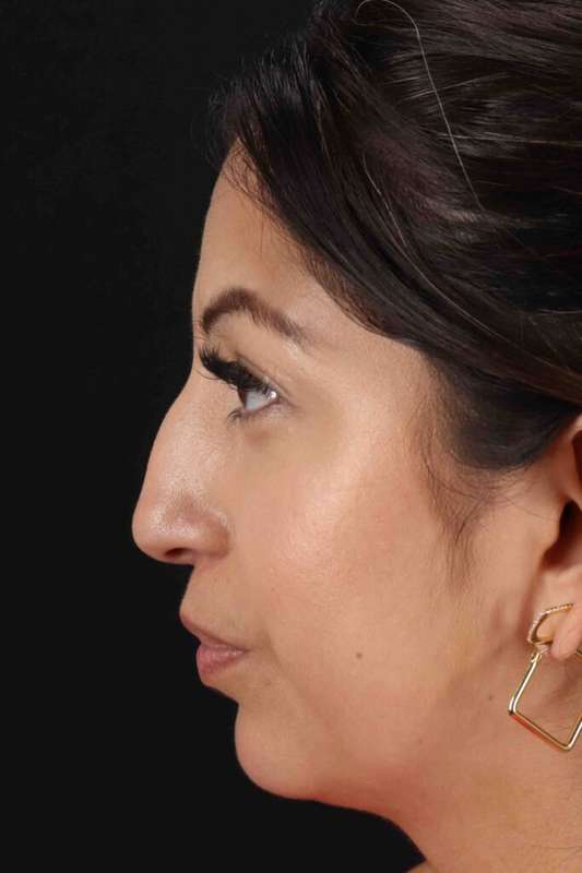 Rhinoplasty Before & After Patient #3049