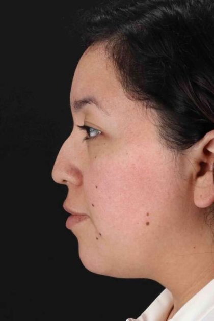 Rhinoplasty Before & After Patient #3060