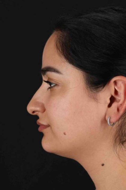 Rhinoplasty Before & After Patient #3071