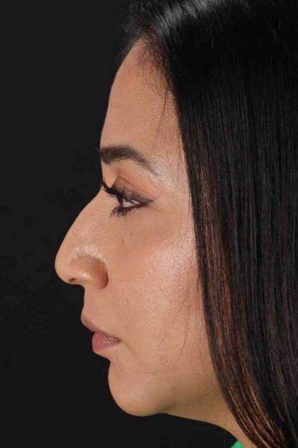 Rhinoplasty Before & After Patient #3082