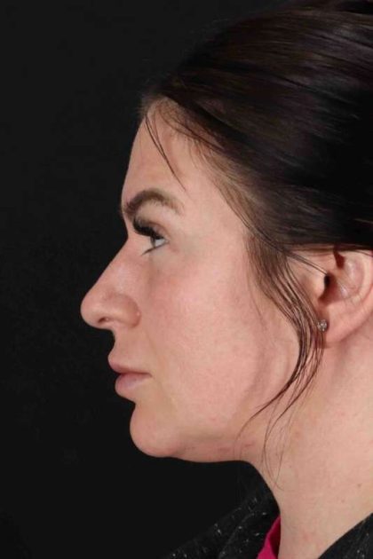 Rhinoplasty Before & After Patient #3093