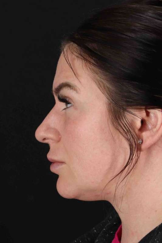 Rhinoplasty Before & After Patient #3093