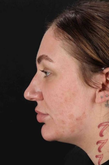 Rhinoplasty Before & After Patient #3104