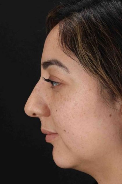 Rhinoplasty Before & After Patient #3115