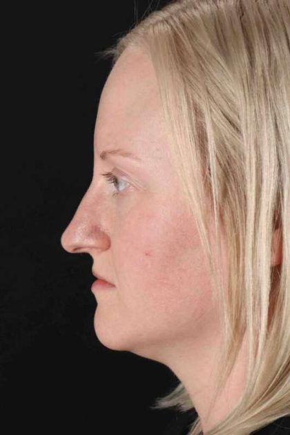Rhinoplasty Before & After Patient #3126