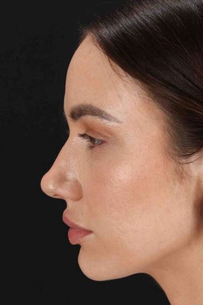 Rhinoplasty Before & After Patient #3137