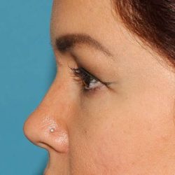 Browlift Before & After Patient #1384