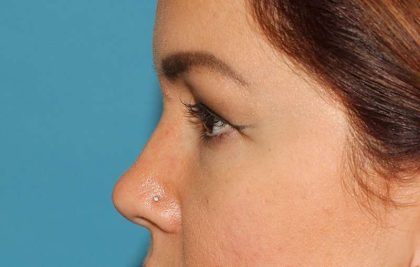 Browlift Before & After Patient #1384
