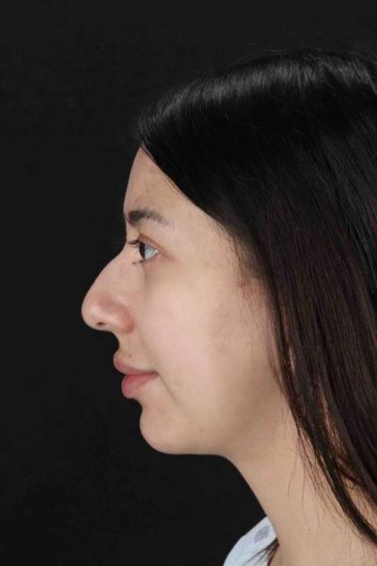 Rhinoplasty Before & After Patient #3159