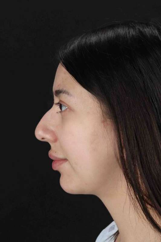 Rhinoplasty Before & After Patient #3159