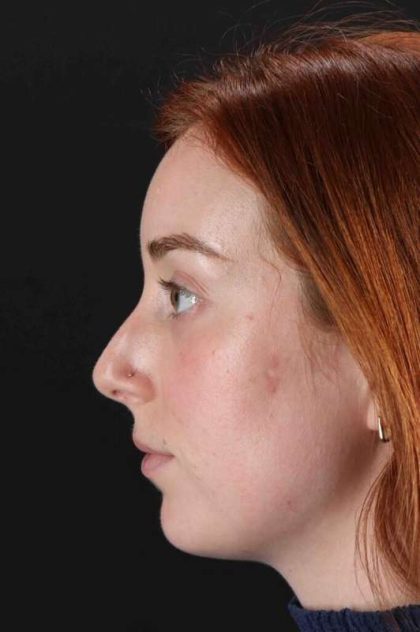 Rhinoplasty Before & After Patient #3170