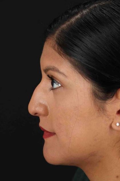 Rhinoplasty Before & After Patient #3181