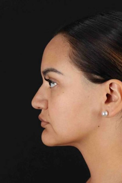 Rhinoplasty Before & After Patient #3192