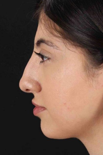 Rhinoplasty Before & After Patient #3214