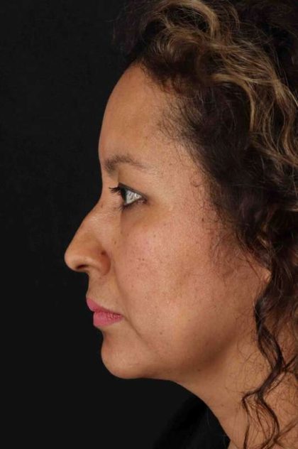 Rhinoplasty Before & After Patient #3225