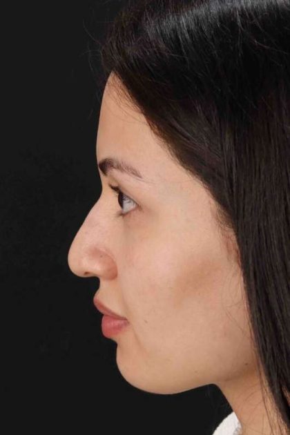 Rhinoplasty Before & After Patient #3236