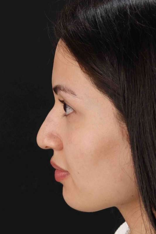Rhinoplasty Before & After Patient #3236